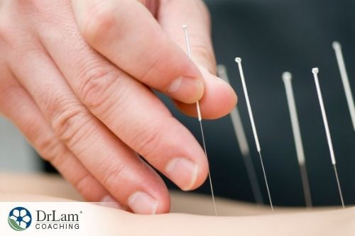 An image of acupuncture being performed